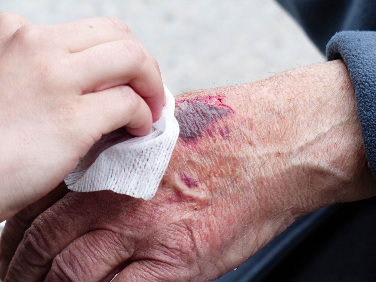 wond-care-hand